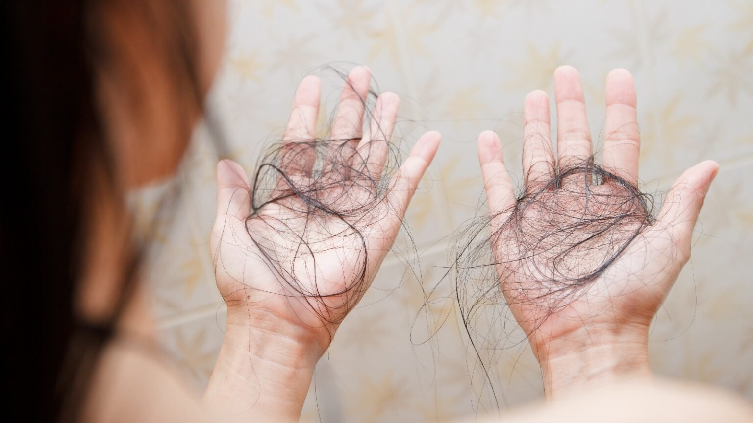 International Alopecia 2025: Cosmetic Surgeons explain why autoimmune hair loss is on the rise
